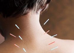 Acupuncture of Backache